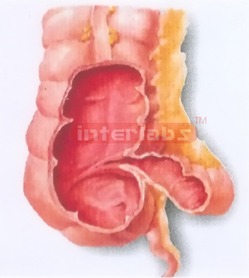 HUMAN HEALTH ILEOCECAL PART (INTERNAL ASPECT) MODEL